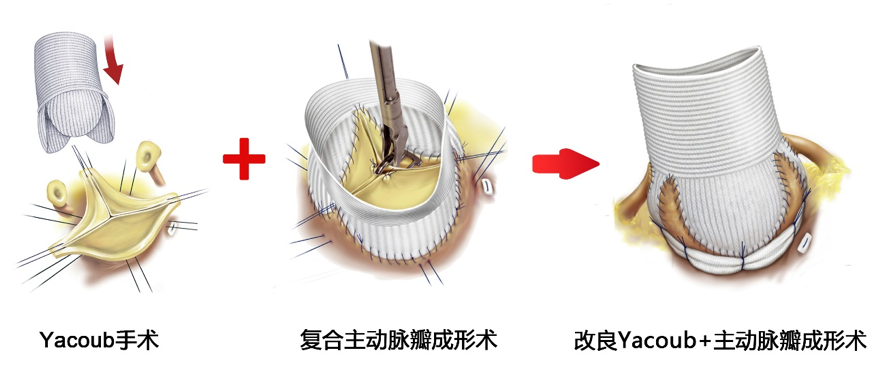 瓣膜最新技术，重塑心脏健康未来之路